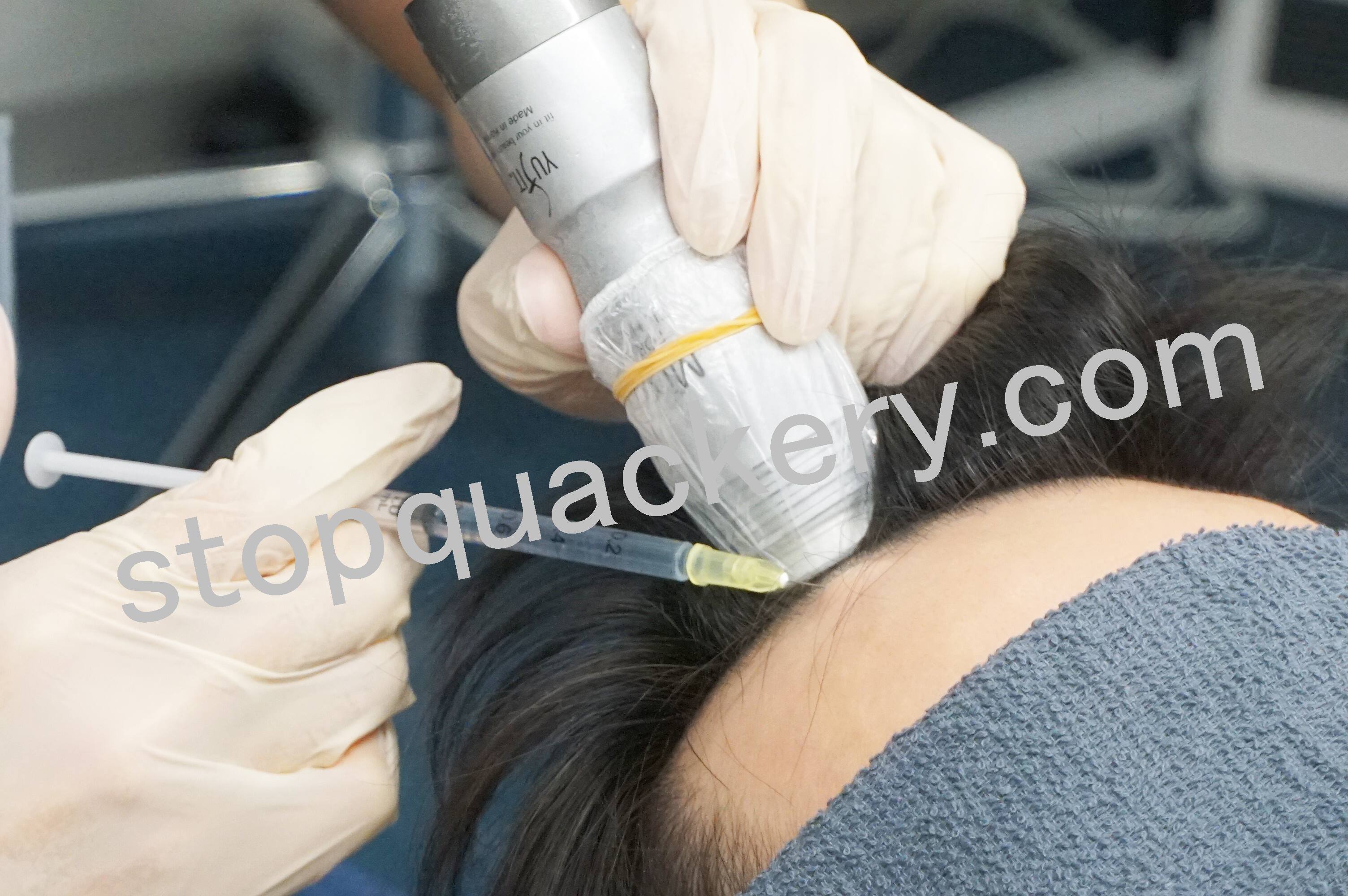 AGAスキンクリニックのクールセンスの治療