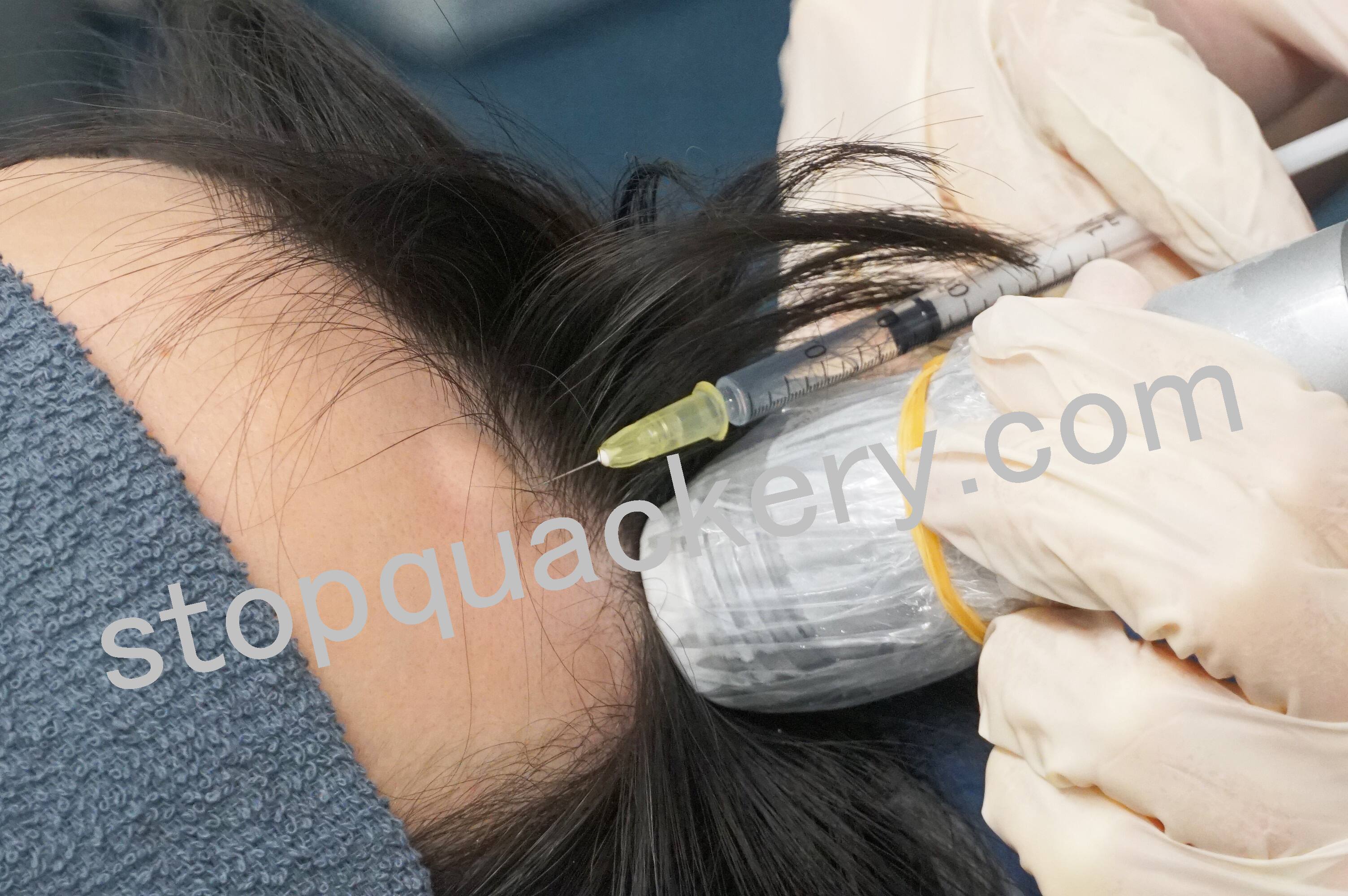 AGAスキンクリニックの薬を注射器で注入