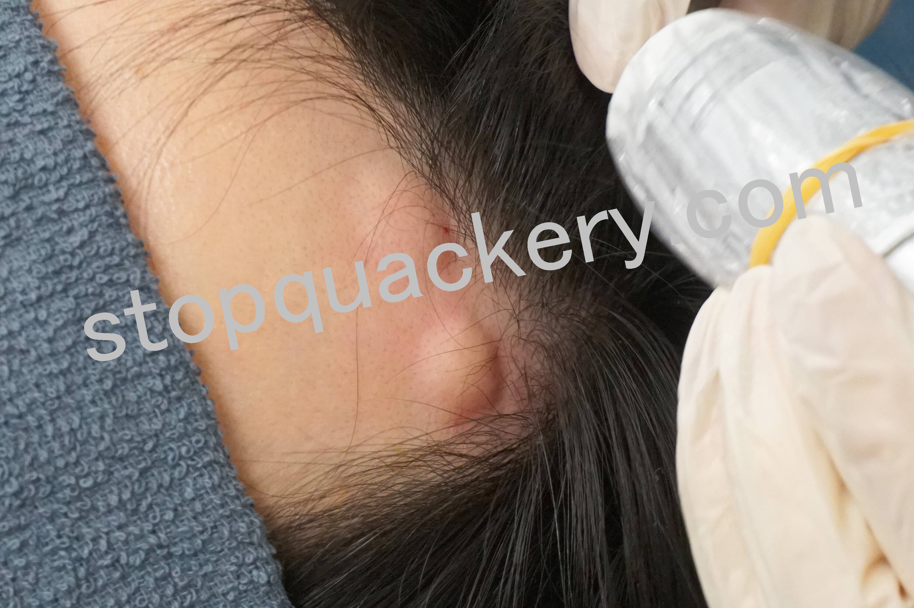 AGAスキンクリニックの薬が注入された頭部の状態